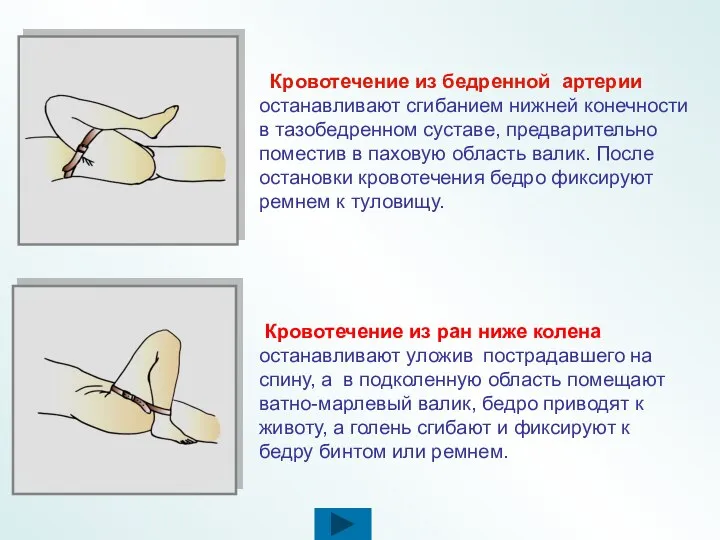 Кровотечение из бедренной артерии останавливают сгибанием нижней конечности в тазобедренном суставе,