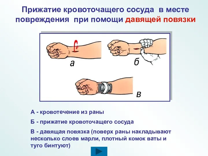 А - кровотечение из раны Б - прижатие кровоточащего сосуда В