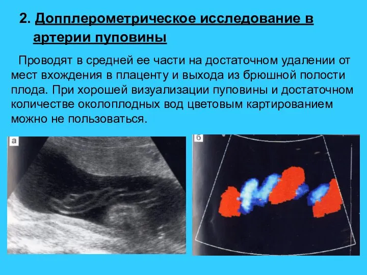 2. Допплерометрическое исследование в артерии пуповины Проводят в средней ее части