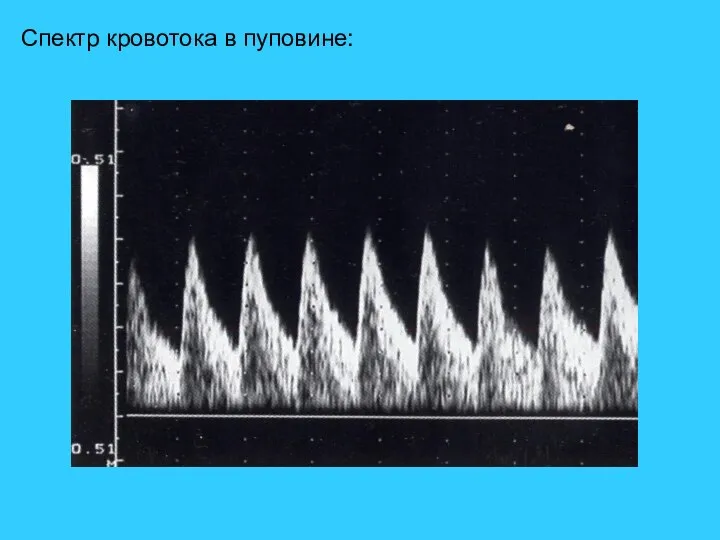 Спектр кровотока в пуповине: