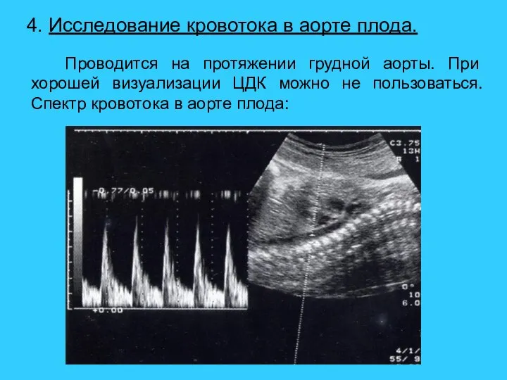 4. Исследование кровотока в аорте плода. Проводится на протяжении грудной аорты.