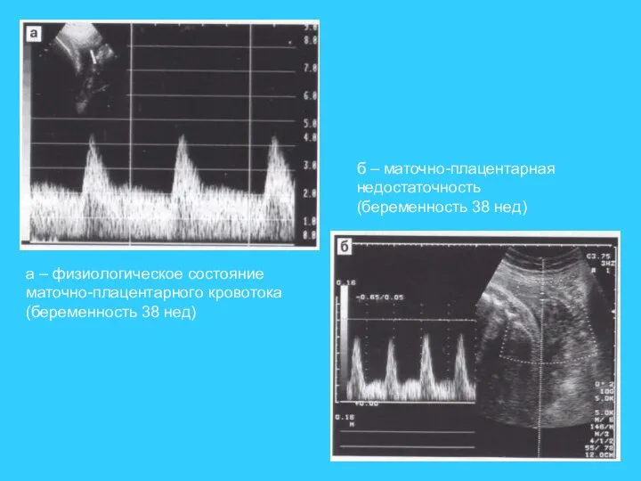 а – физиологическое состояние маточно-плацентарного кровотока (беременность 38 нед) б – маточно-плацентарная недостаточность (беременность 38 нед)