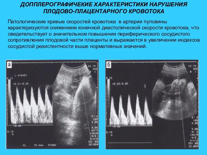 ДОППЛЕРОГРАФИЧЕКИЕ ХАРАКТЕРИСТИКИ НАРУШЕНИЯ ПЛОДОВО-ПЛАЦЕНТАРНОГО КРОВОТОКА Патологические кривые скоростей кровотока в артерии