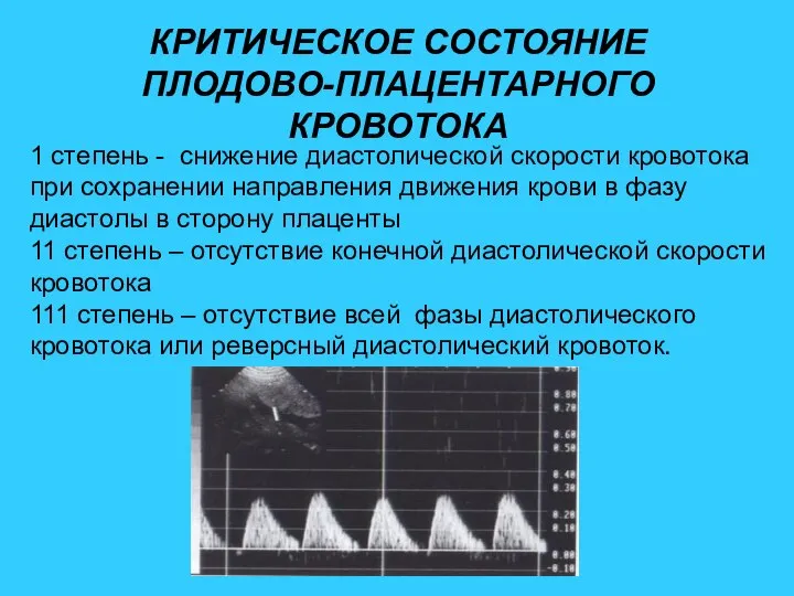 КРИТИЧЕСКОЕ СОСТОЯНИЕ ПЛОДОВО-ПЛАЦЕНТАРНОГО КРОВОТОКА 1 степень - снижение диастолической скорости кровотока