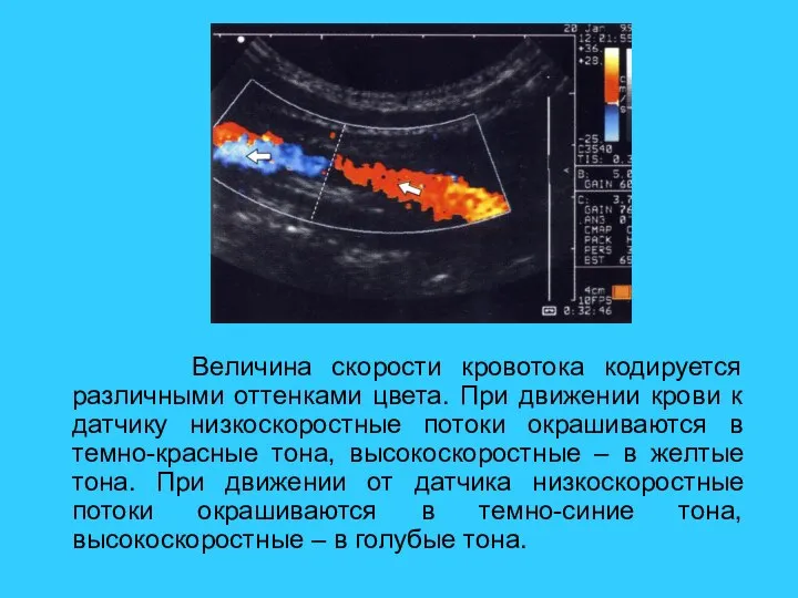 Величина скорости кровотока кодируется различными оттенками цвета. При движении крови к