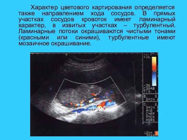 Характер цветового картирования определяется также направлением хода сосудов. В прямых участках