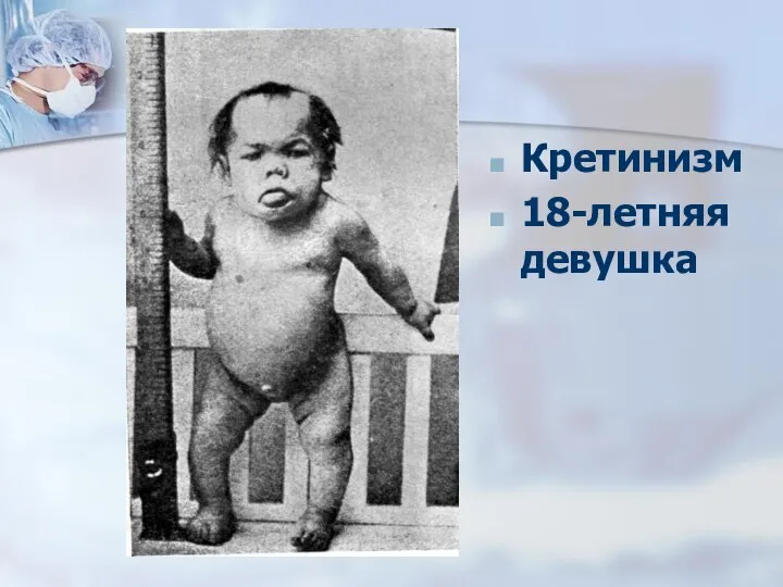 Кретинизм 18-летняя девушка