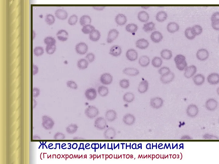 Железодефицитная анемия (Гипохромия эритроцитов, микроцитоз)