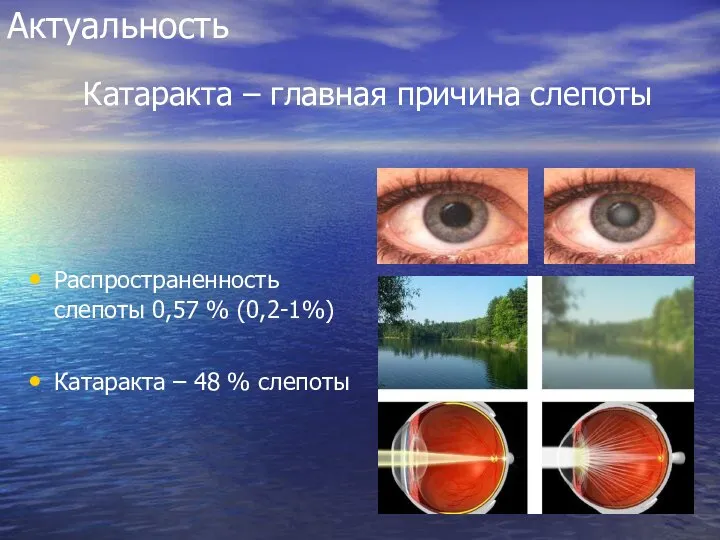 Актуальность Распространенность слепоты 0,57 % (0,2-1%) Катаракта – 48 % слепоты Катаракта – главная причина слепоты