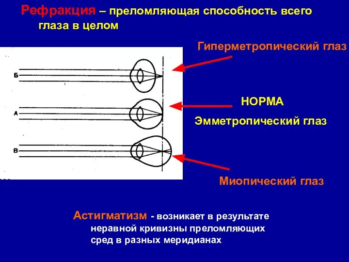 Рефракция – преломляющая способность всего глаза в целом Гиперметропический глаз Миопический