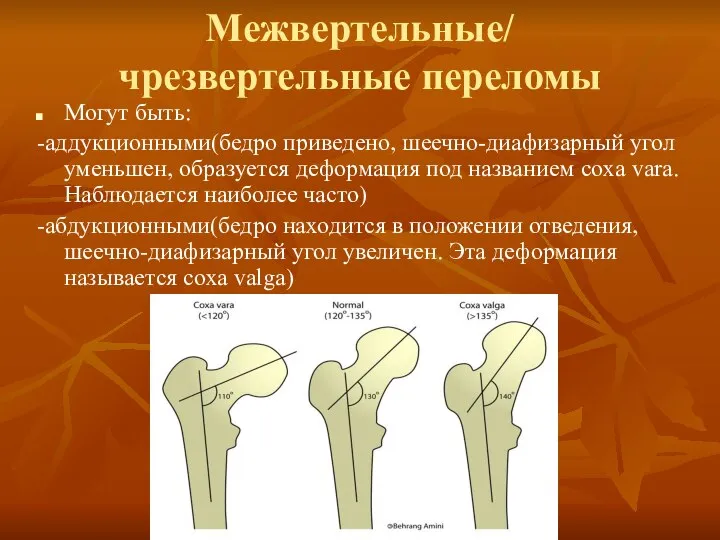 Межвертельные/ чрезвертельные переломы Могут быть: -аддукционными(бедро приведено, шеечно-диафизарный угол уменьшен, образуется