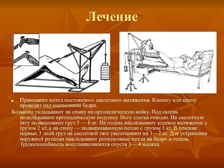 Лечение Применяют метод постоянного скелетного вытяжения. Клемму или спицу проводят над