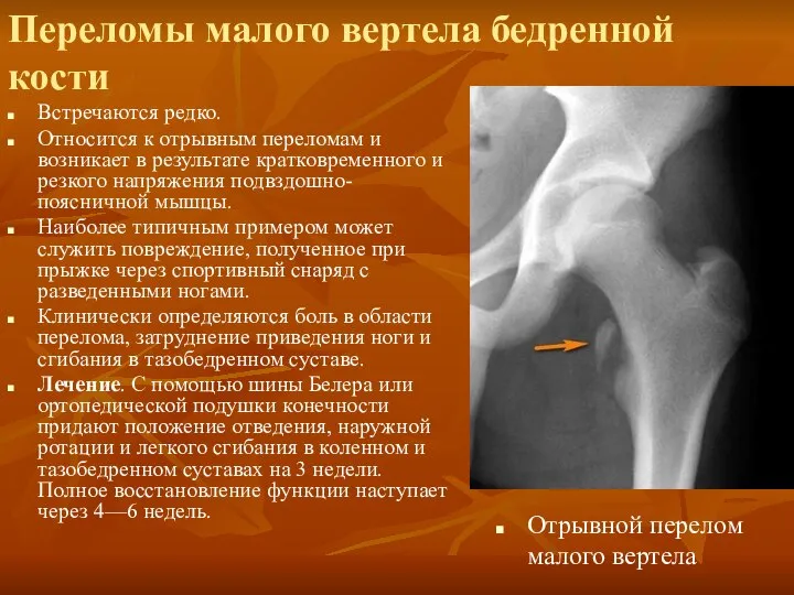 Переломы малого вертела бедренной кости Встречаются редко. Относится к отрывным переломам