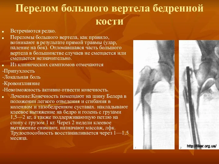 Перелом большого вертела бедренной кости Встречаются редко. Переломы большого вертела, как