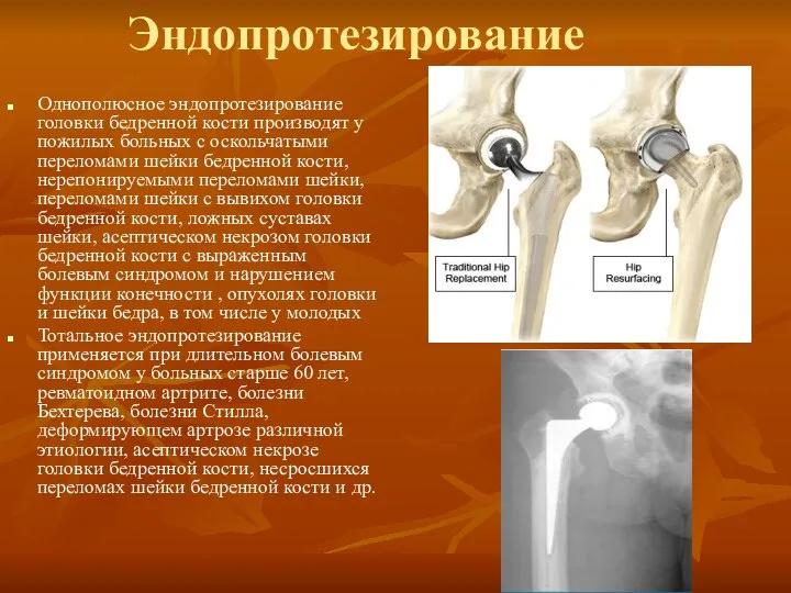 Эндопротезирование Однополюсное эндопротезирование головки бедренной кости производят у пожилых больных с