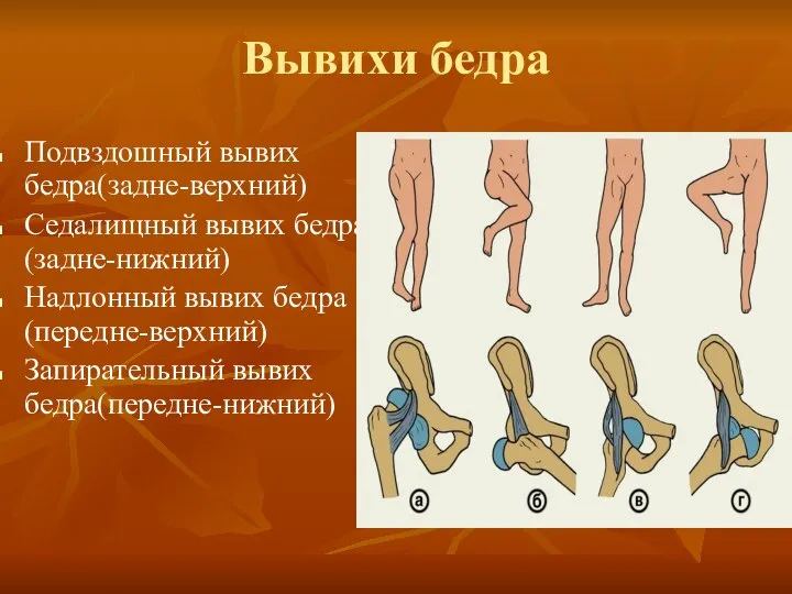 Вывихи бедра Подвздошный вывих бедра(задне-верхний) Седалищный вывих бедра(задне-нижний) Надлонный вывих бедра(передне-верхний) Запирательный вывих бедра(передне-нижний)