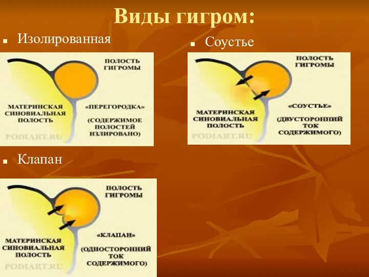 Виды гигром: Изолированная Клапан Соустье