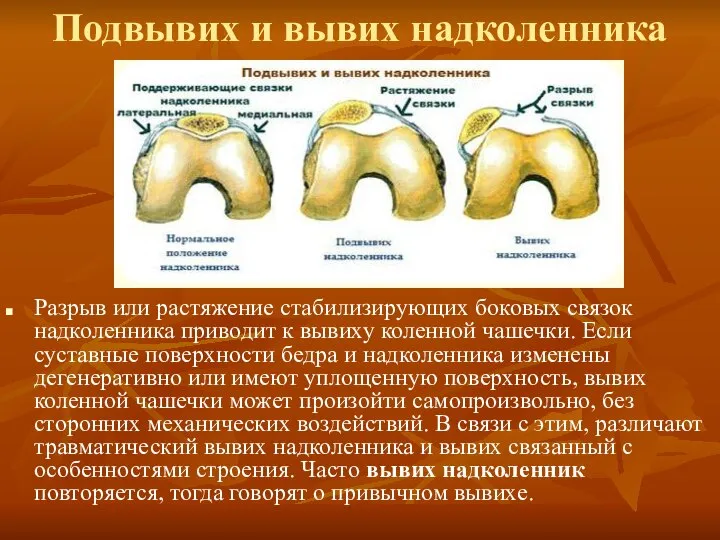 Подвывих и вывих надколенника Разрыв или растяжение стабилизирующих боковых связок надколенника