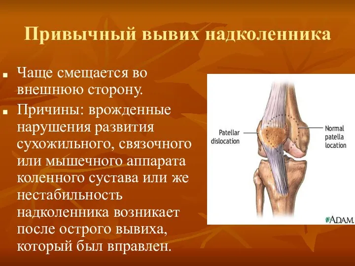 Привычный вывих надколенника Чаще смещается во внешнюю сторону. Причины: врожденные нарушения