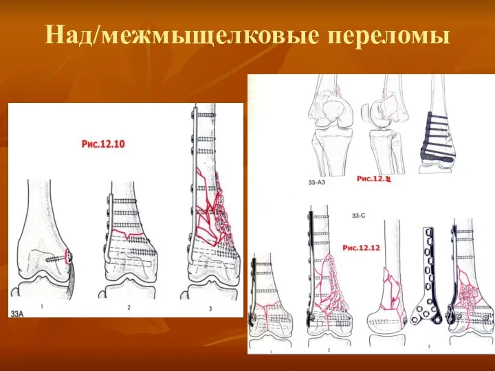 Над/межмыщелковые переломы