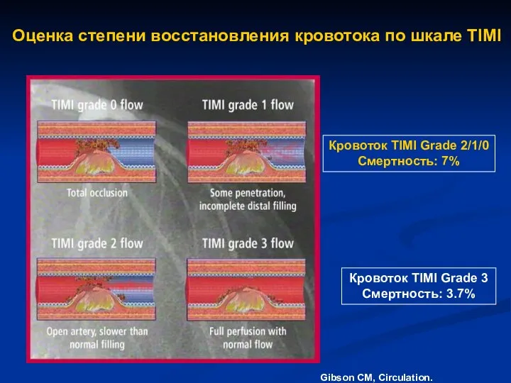 Оценка степени восстановления кровотока по шкале TIMI Кровоток TIMI Grade 3