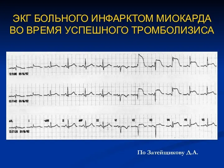 ЭКГ БОЛЬНОГО ИНФАРКТОМ МИОКАРДА ВО ВРЕМЯ УСПЕШНОГО ТРОМБОЛИЗИСА По Затейщикову Д.А.