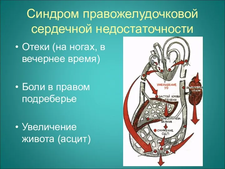 Синдром правожелудочковой сердечной недостаточности Отеки (на ногах, в вечернее время) Боли