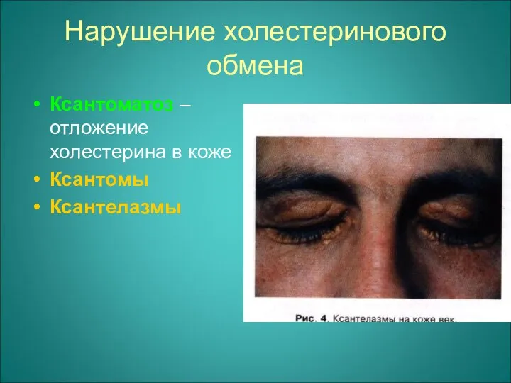 Нарушение холестеринового обмена Ксантоматоз – отложение холестерина в коже Ксантомы Ксантелазмы