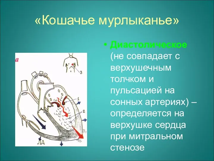 «Кошачье мурлыканье» Диастолическое (не совпадает с верхушечным толчком и пульсацией на