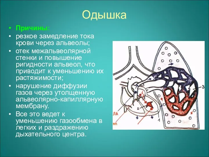 Одышка Причины: резкое замедление тока крови через альвеолы; отек межальвеолярной стенки