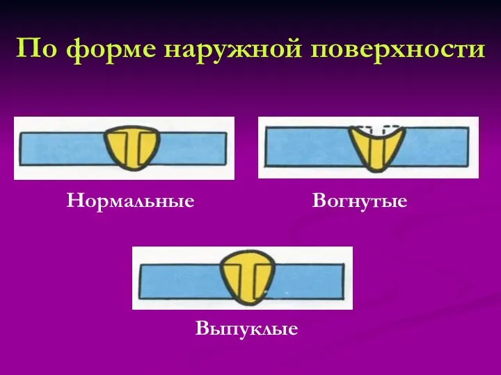 По форме наружной поверхности Нормальные Вогнутые Выпуклые