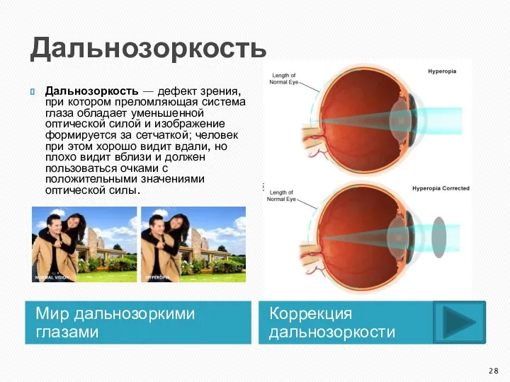 Дальнозоркость Мир дальнозоркими глазами Коррекция дальнозоркости Дальнозоркость — дефект зрения, при