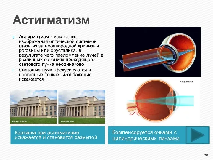 Астигматизм Картинка при астигматизме искажается и становится размытой Компенсируется очками с