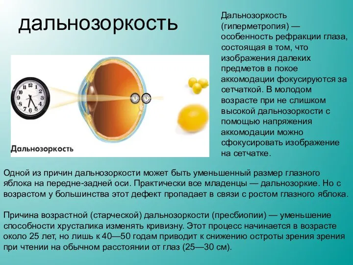 дальнозоркость Дальнозоркость (гиперметропия) — особенность рефракции глаза, состоящая в том, что