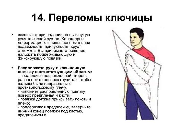 14. Переломы ключицы возникают при падении на вытянутую руку, плечевой сустав.