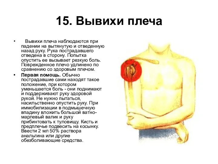 15. Вывихи плеча Вывихи плеча наблюдаются при падении на вытянутую и