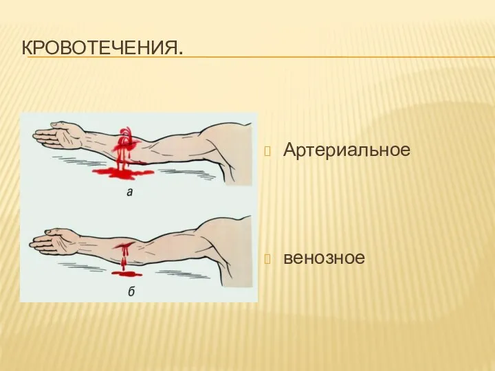 Кровотечения. Артериальное венозное