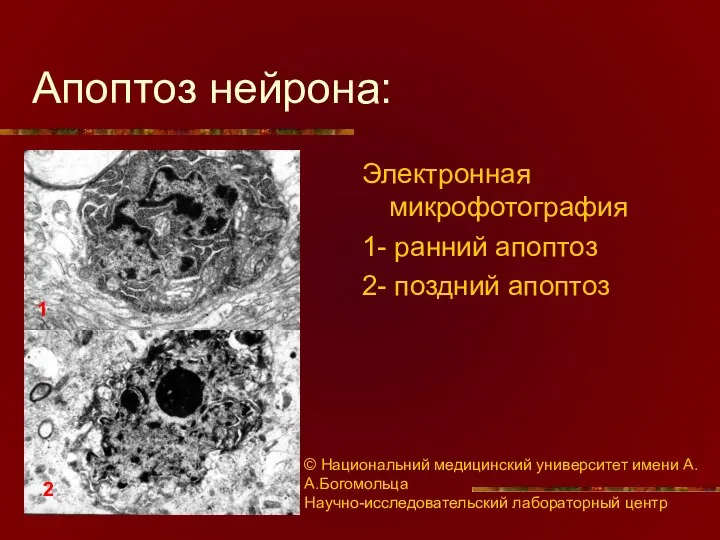 Апоптоз нейрона: Электронная микрофотография 1- ранний апоптоз 2- поздний апоптоз 1