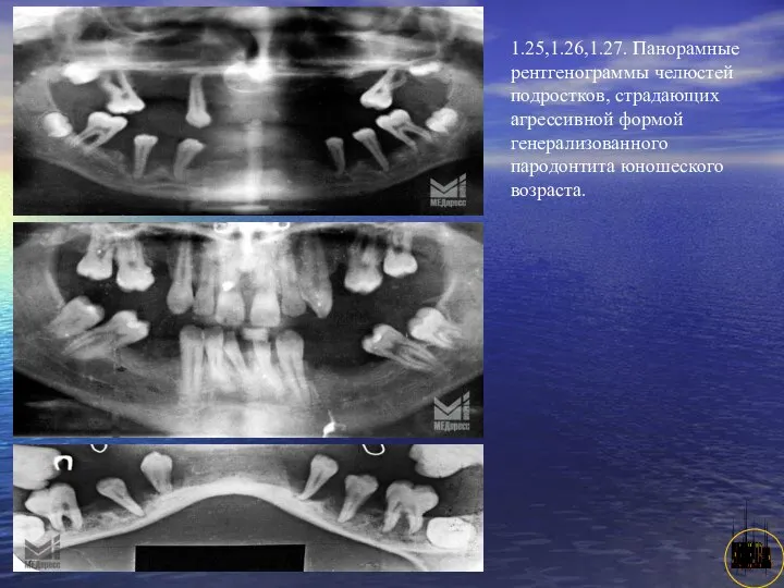 АНИСИМОВА Л.В.кмн. 1.25,1.26,1.27. Панорамные рентгенограммы челюстей подростков, страдающих агрессивной формой генерализованного пародонтита юношеского возраста.