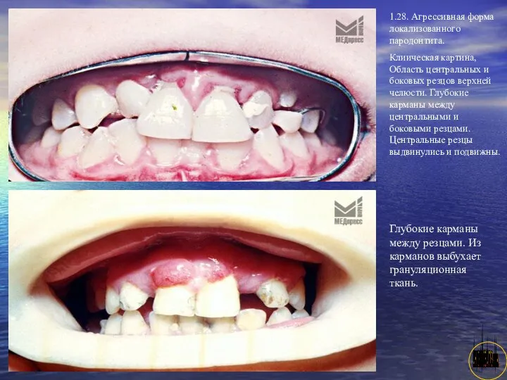 АНИСИМОВА Л.В.кмн. 1.28. Агрессивная форма локализованного пародонтита. Клиическая картина, Область центральных