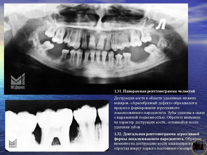 АНИСИМОВА Л.В.кмн. 1.31. Панорамная рентгенограмма челюстей Деструкция кости в области удаленных