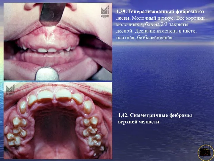 АНИСИМОВА Л.В.кмн. 1.39. Генерализованный фиброматоз десен. Молочный прикус. Все коронки молочных