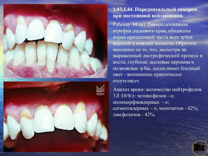 АНИСИМОВА Л.В.кмн. 1.43,1.44. Пародонтальный синдром при постоянной нейтропении. Ребенку 14 лет.