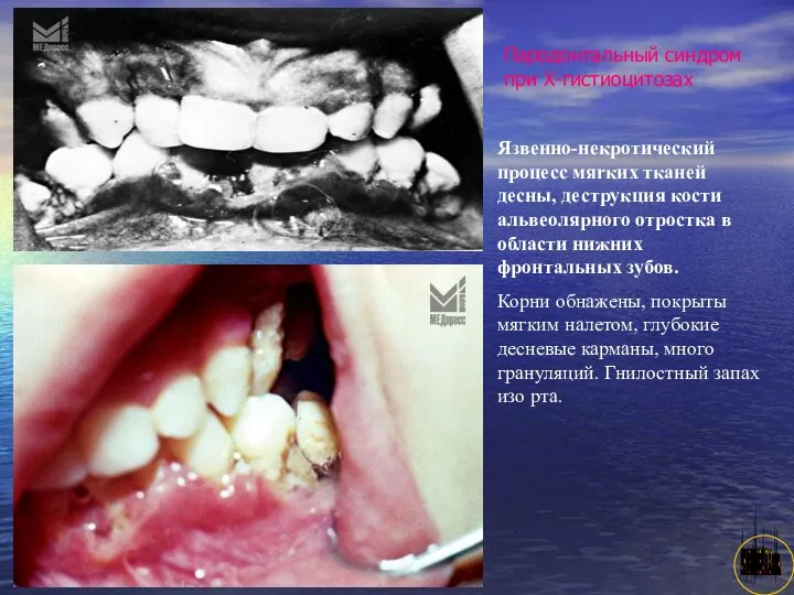 АНИСИМОВА Л.В.кмн. Пародонтальный синдром при Х-гистиоцитозах Язвенно-некротический процесс мяrкиx тканей десны,