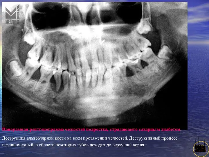 АНИСИМОВА Л.В.кмн. Панорамная рентгенограмма челюстей подростка, страдающего сахарным диабетом. Деструкция альвеолярной