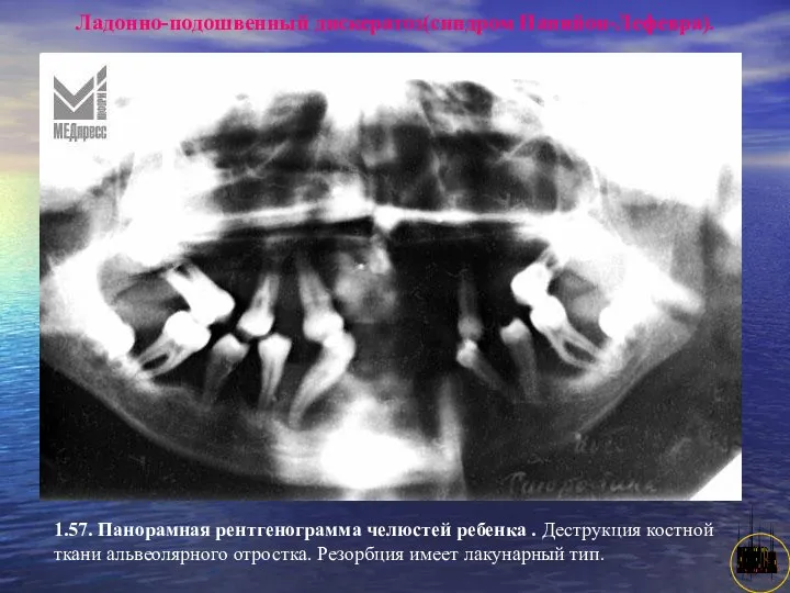 АНИСИМОВА Л.В.кмн. Ладонно-подошвенный дискератоз(синдром Папийон-Лефевра). 1.57. Панорамная рентгенограмма челюстей ребенка .