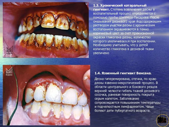 АНИСИМОВА Л.В.кмн. 1.3. Хронический катаральный гингивит. Степень вовлечения десны в воспалительный