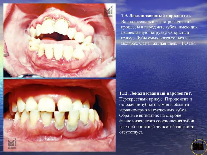 АНИСИМОВА Л.В.кмн. 1.9. Локализованный пародонтит. Воспалительный и дистрофический процессы в пародонте