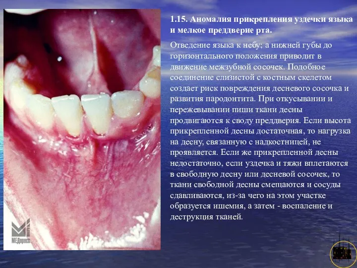 АНИСИМОВА Л.В.кмн. 1.15. Аномалия прикрепления уздечки языка и мелкое преддверие рта.