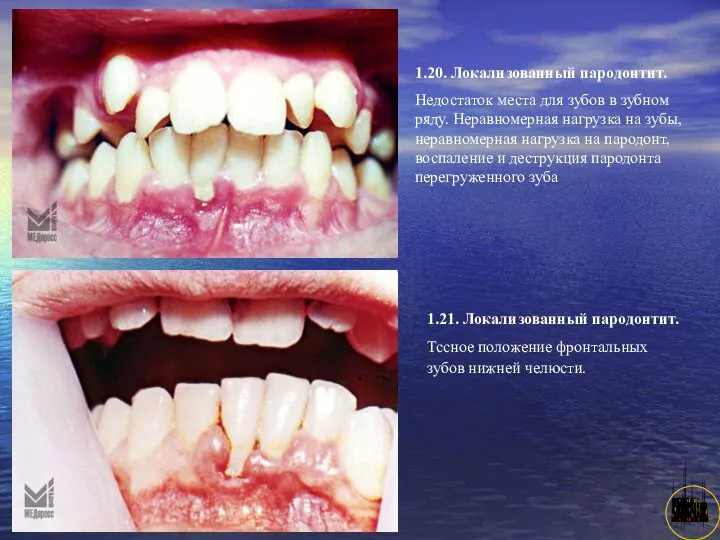 АНИСИМОВА Л.В.кмн. 1.20. Локализованный пародонтит. Недостаток места для зубов в зубном